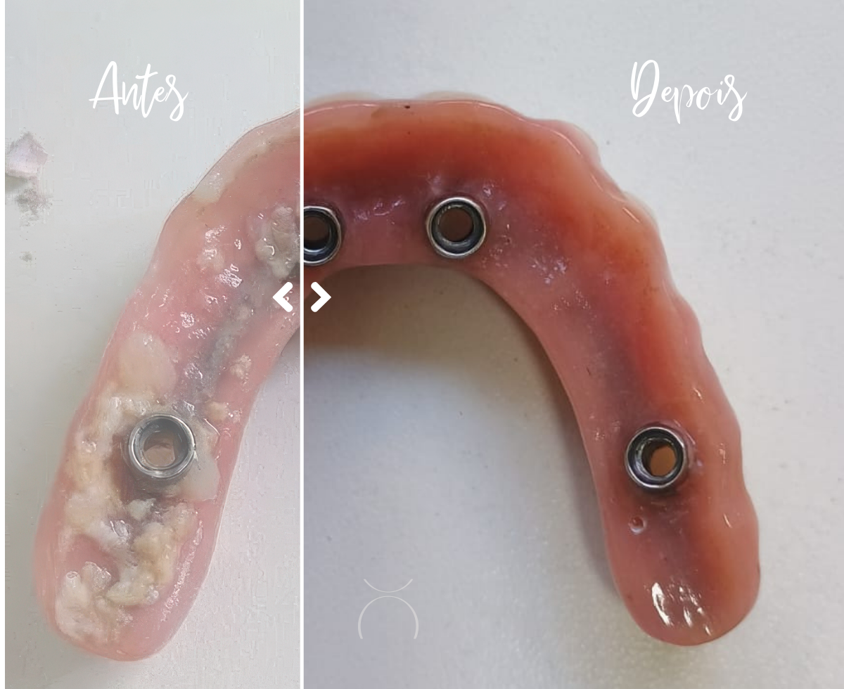 Manutenção e limpeza da prótese protocolo