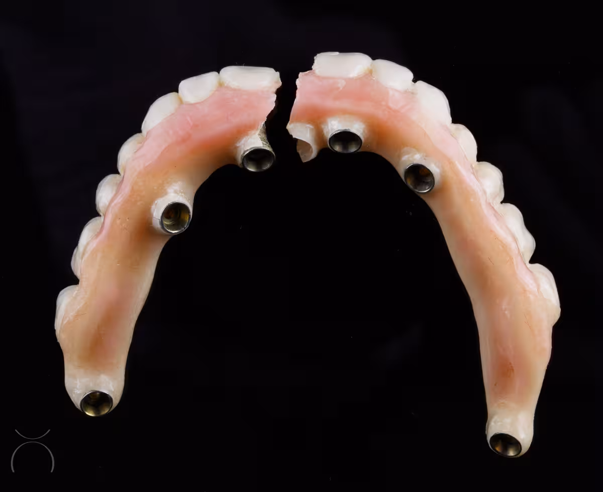 Fratura da barra metálica interna da prótese protocolo