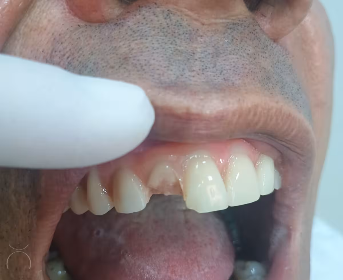 Dente de acrílico fraturado em prótese protocolo fixa
