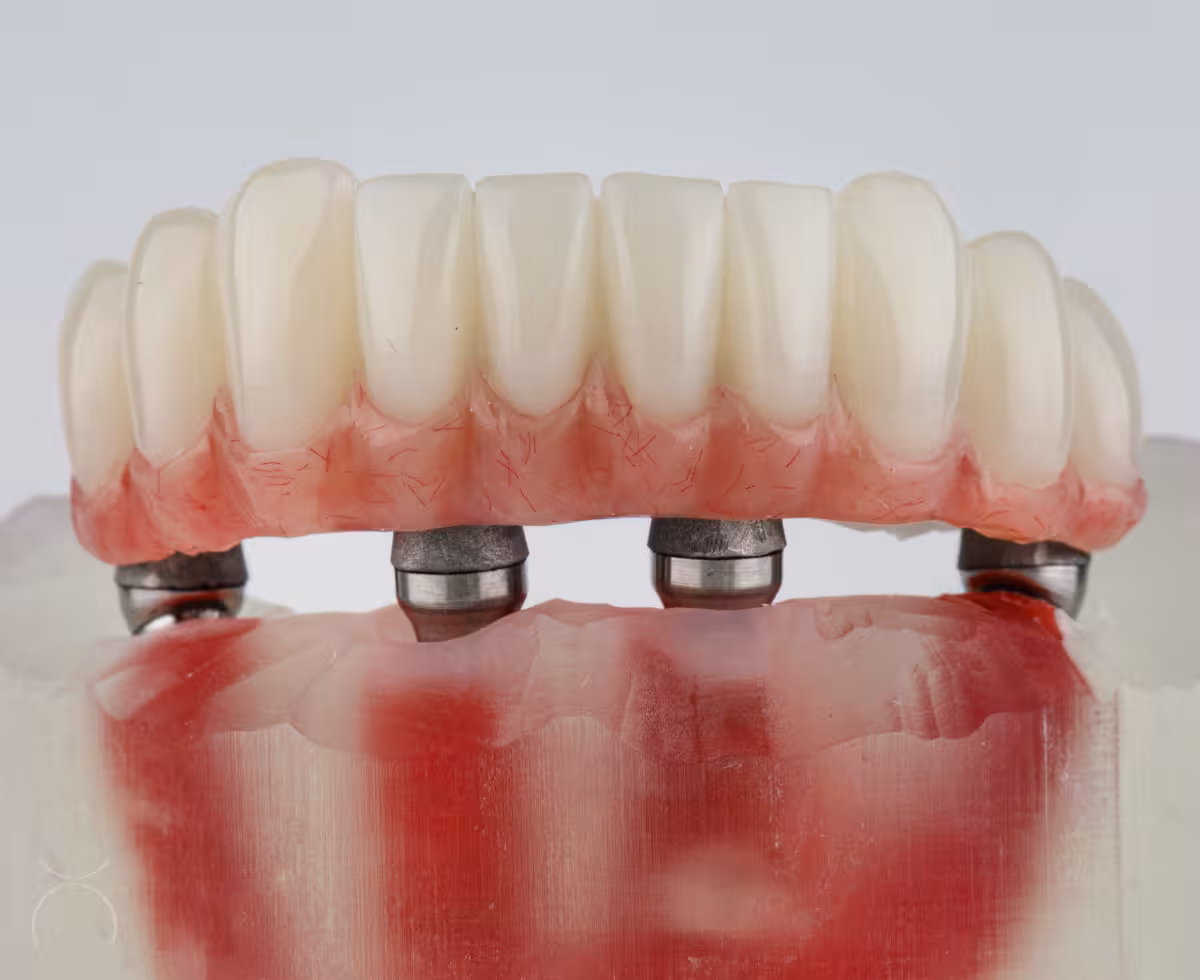 Espaço biológico peri-implantar da prótese protocolo